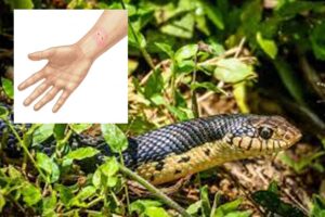 snake bite